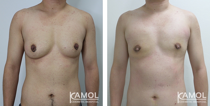 Before and After Mastectomy (Top Surgery)  U-Shape Scar technique