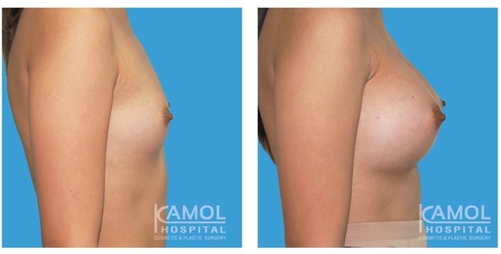 Male to Female Breast Surgery