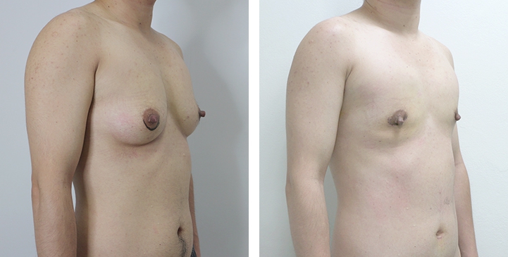 Before and After Mastectomy (Top Surgery)  U-Shape Scar technique