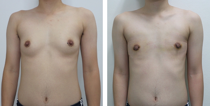 Before and After Mastectomy (Top Surgery)  U-Shape Scar technique