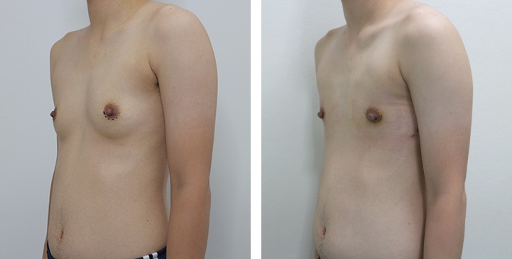 Before and After Mastectomy (Top Surgery)  U-Shape Scar technique