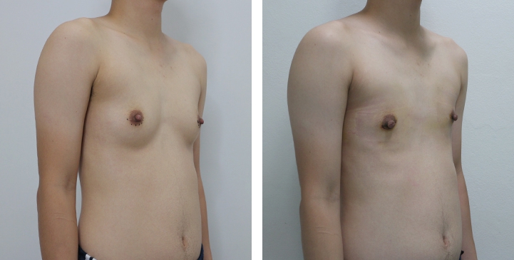 Before and After Mastectomy (Top Surgery)  U-Shape Scar technique