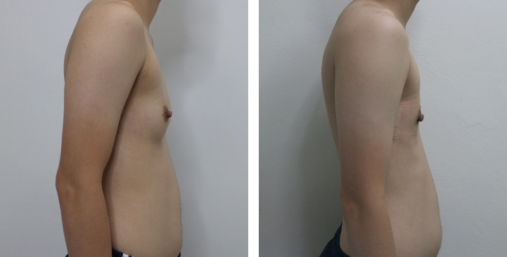 Before and After Mastectomy (Top Surgery)  U-Shape Scar technique