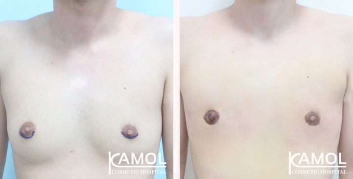 Before and After Mastectomy (Top Surgery)  U-Shape Scar technique