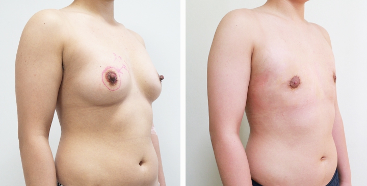 Before and After Mastectomy (Top Surgery) O-Shape Scar technique