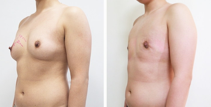 Before and After Mastectomy (Top Surgery) O-Shape Scar technique