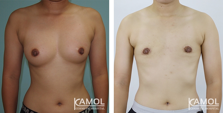 Before and After Mastectomy (Top Surgery) O-Shape Scar technique