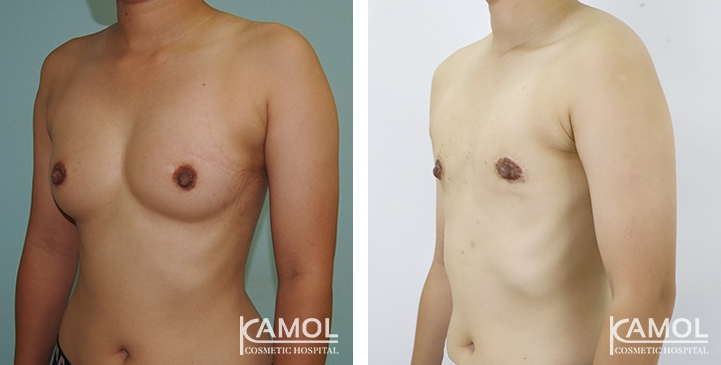 Before and After Mastectomy (Top Surgery) O-Shape Scar technique