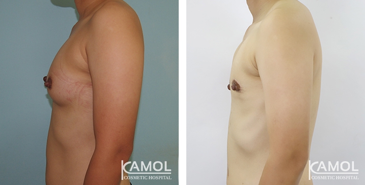 Before and After Mastectomy (Top Surgery) O-Shape Scar technique