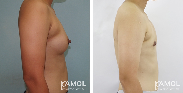 Before and After Mastectomy (Top Surgery) O-Shape Scar technique