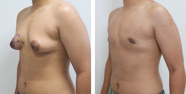 Before and After Mastectomy (Top Surgery) O-Shape Scar technique