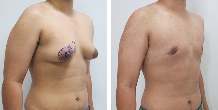 Before and After Mastectomy (Top Surgery) O-Shape Scar technique