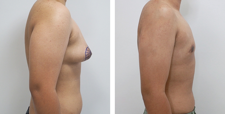 Before and After Mastectomy (Top Surgery) O-Shape Scar technique