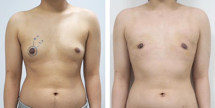 Before and After Mastectomy (Top Surgery) O-Shape Scar technique