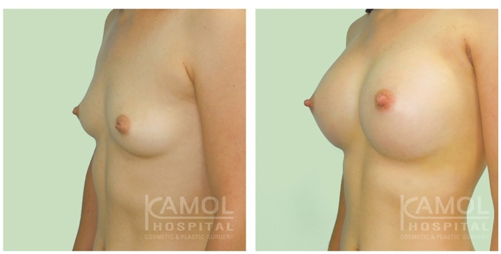 Male to Female Breast Surgery