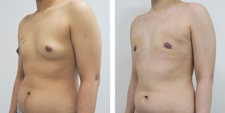 Before and After Mastectomy (Top Surgery) O-Shape Scar technique