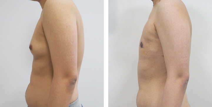 Before and After Mastectomy (Top Surgery) O-Shape Scar technique