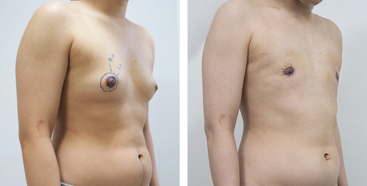 Before and After Mastectomy (Top Surgery) O-Shape Scar technique