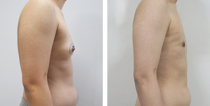 Before and After Mastectomy (Top Surgery) O-Shape Scar technique