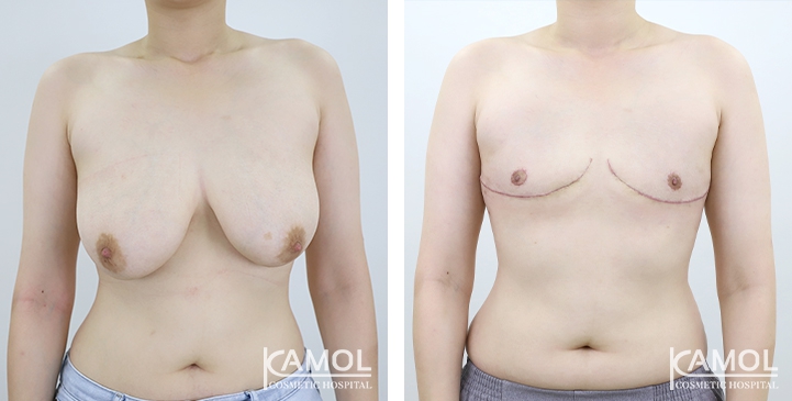 Before and After Mastectomy (Top Surgery) 