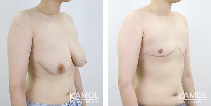Before and After Mastectomy (Top Surgery) 
