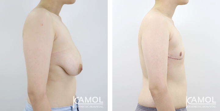 Before and After Mastectomy (Top Surgery) 