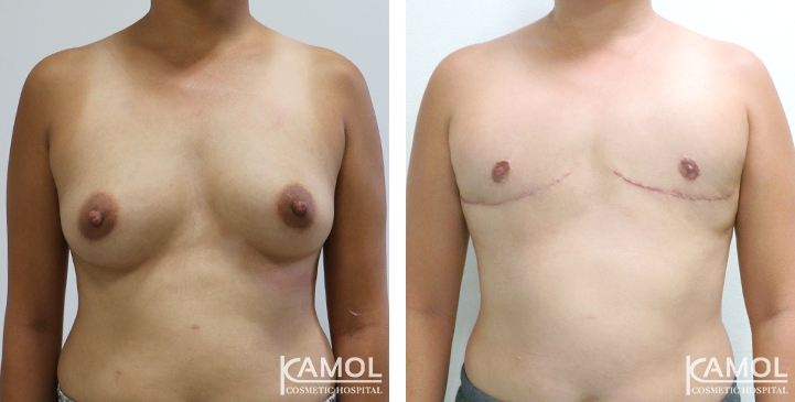 Before and After Mastectomy (Top Surgery) 