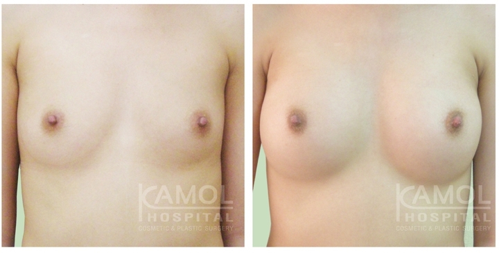 Male to Female Breast Surgery