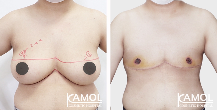 Before and After Mastectomy (Top Surgery) 