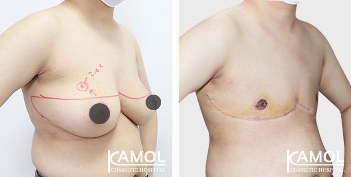 Before and After Mastectomy (Top Surgery) 