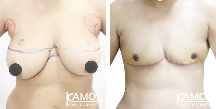 Before and After Mastectomy (Top Surgery) with Under arm Liposuction 