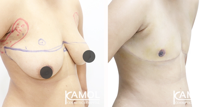 Before and After Mastectomy (Top Surgery) with Under arm Liposuction