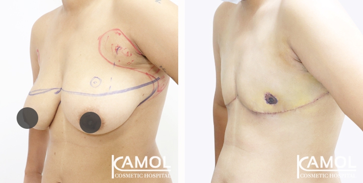 Before and After Mastectomy (Top Surgery) with Under arm Liposuction