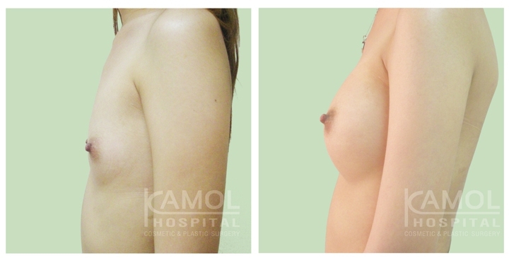 Male to Female Breast Surgery