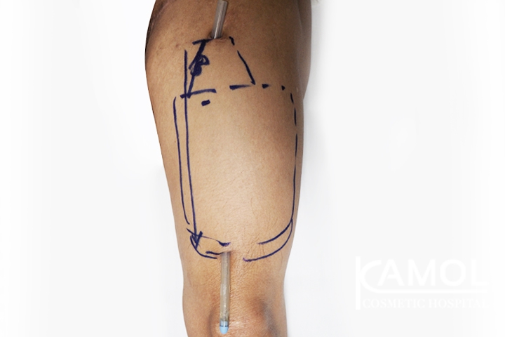 Urethral prefabrication with skin marking for surgery