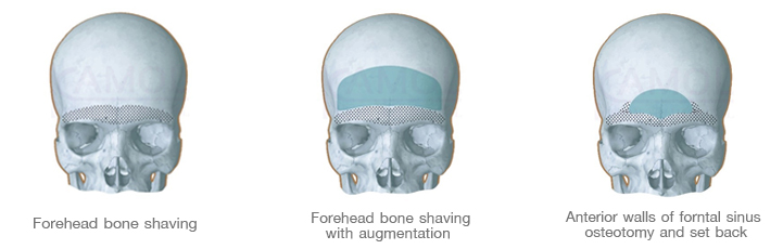 the_procedures_of_feminine_forehead_contouring.