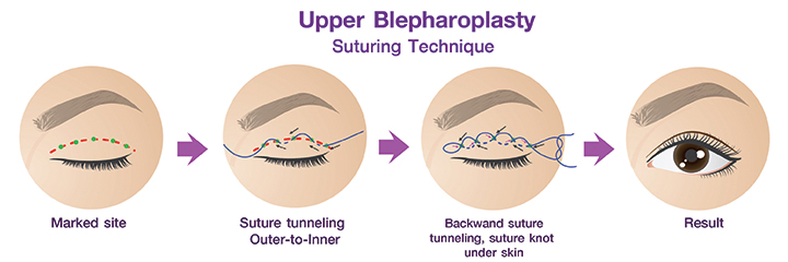 shows the procedure for Double eyelid surgery by the Suturing technique.