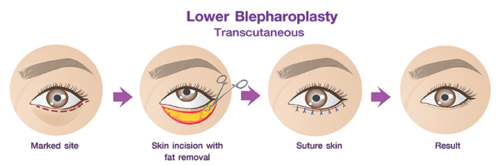 Shows the transcutaneous lower eyelid procedure