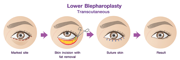 the_transcutaneous_lower_eyelid_procedure