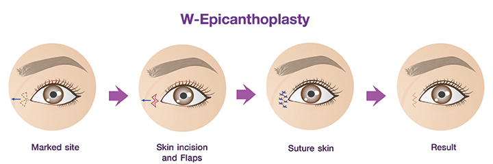 W-Epicanthoplasty_procedure.
