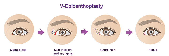 V-Epicanthoplasty_procedure.