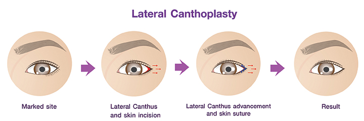 Shows Lateral Canthoplasty procedures.