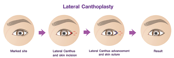 Lateral_Canthoplasty_procedures.