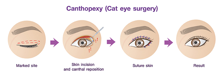 Canthopexy_( Cat_eye_surgery)_procedures.