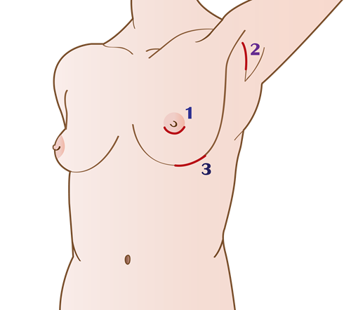 Shows the  incisions of breast augmentation
