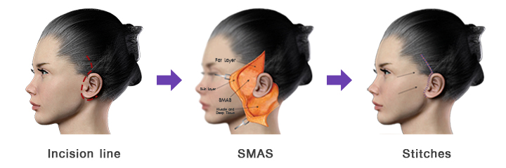 facelift_by_"Deep_tissue_technique_with_SMASectomy."