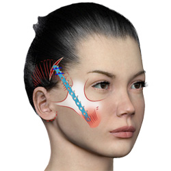 Face_lift_by_deep_muscle_suspension_with_synthetic_absorbable_materials_(Endotine)