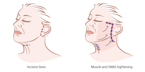 neck_lift_and_neck_tuck_procedures