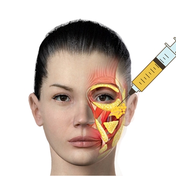 shows the areas of facial fat transfer