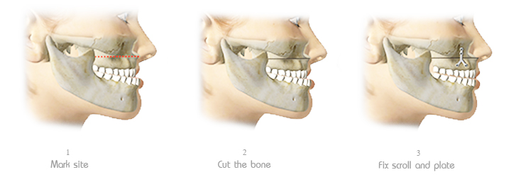 Shows Upper Jaw Surgery